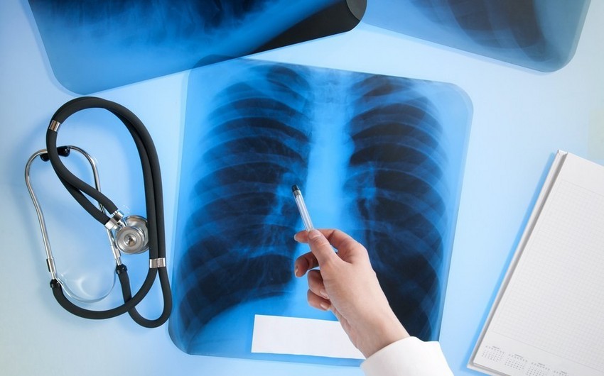 Number of tuberculosis patients made public in Azerbaijan