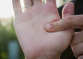 Scars on palms may be symptom of fatal disease
