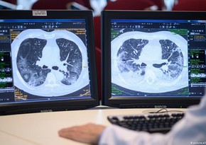 Scientists find reason for COVID death in lungs