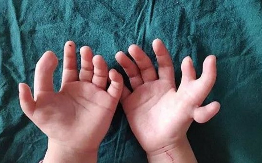 В Китае прооперировали 3-летнюю девочку, родившуюся с 14 пальцами