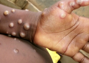 Nearly 92,000 mpox cases identified worldwide since January 2022, WHO says