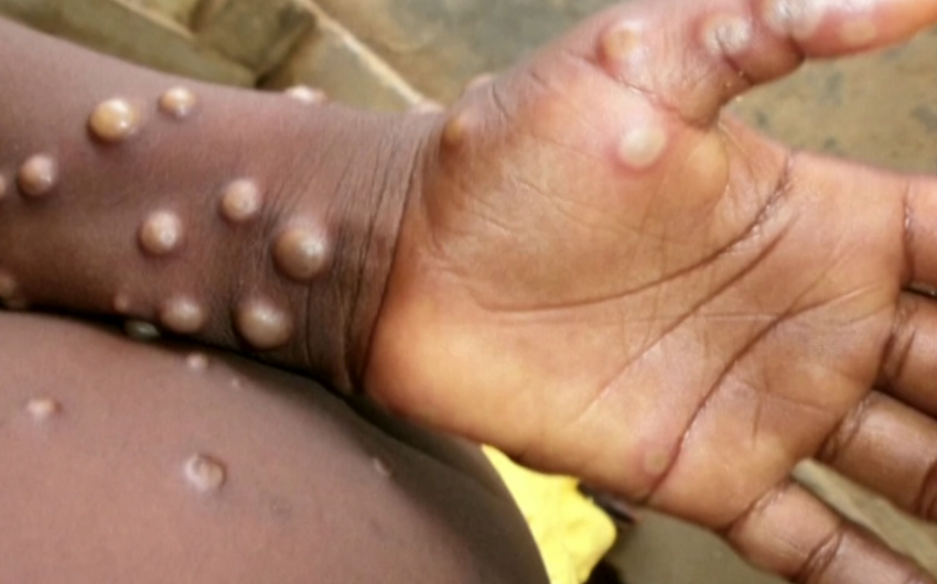 Nearly 92,000 mpox cases identified worldwide since January 2022, WHO says