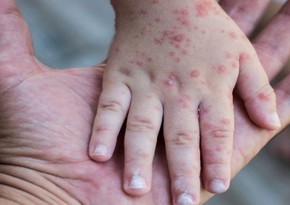 One dead, two infected after meningococcal disease outbreak declared in Toronto