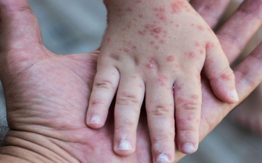 One dead, two infected after meningococcal disease outbreak declared in Toronto