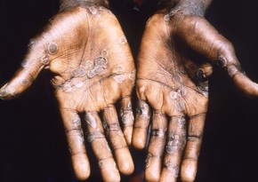 WHO reports 80 confirmed cases of monkeypox in 11 countries 
