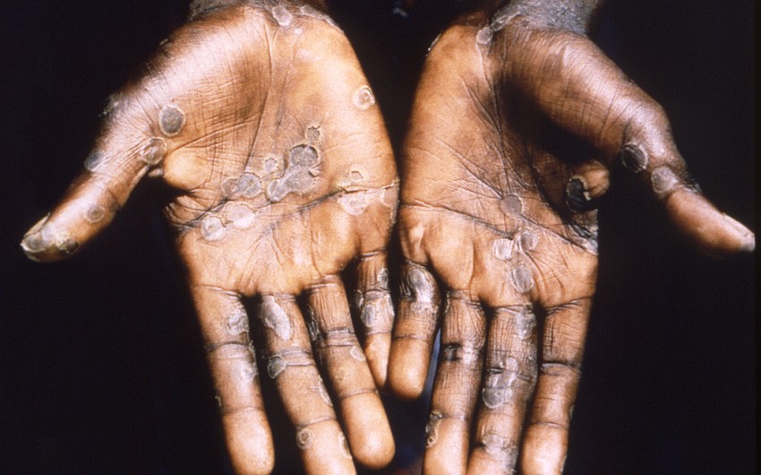 Morocco reports first monkeypox case