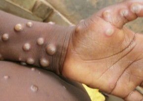 Huge rise in monkey pox cases in DR Congo: Gov't