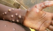 Pakistan reports first Mpox case of 2024