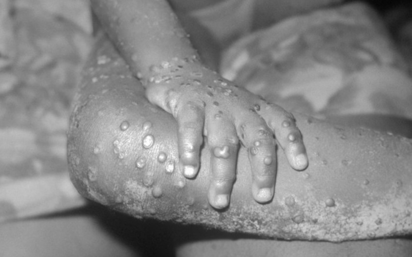 UK confirms seven new cases of monkeypox
