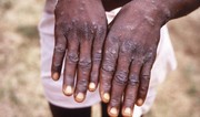 Nigeria reports 39 cases of monkeypox infection