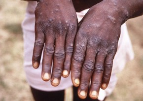 Nigeria reports 39 cases of monkeypox infection