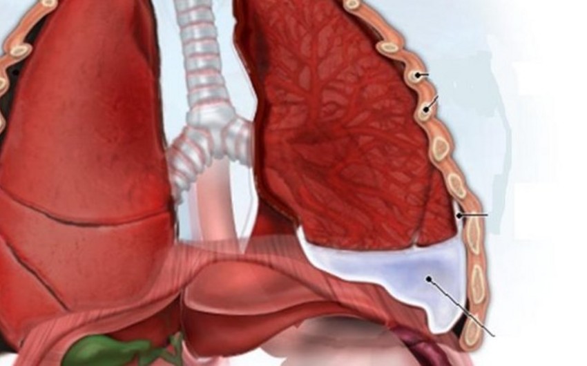 Səhiyyə Nazirliyinin eksperti: Plevrit xəstəliyi yalnız təsadüfi müayinə zamanı aşkar edilir