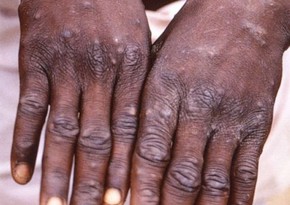 Vietnam reports first case of human infection with monkeypox