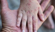 Azerbaijan posts sharp decline in number of measles cases - Official