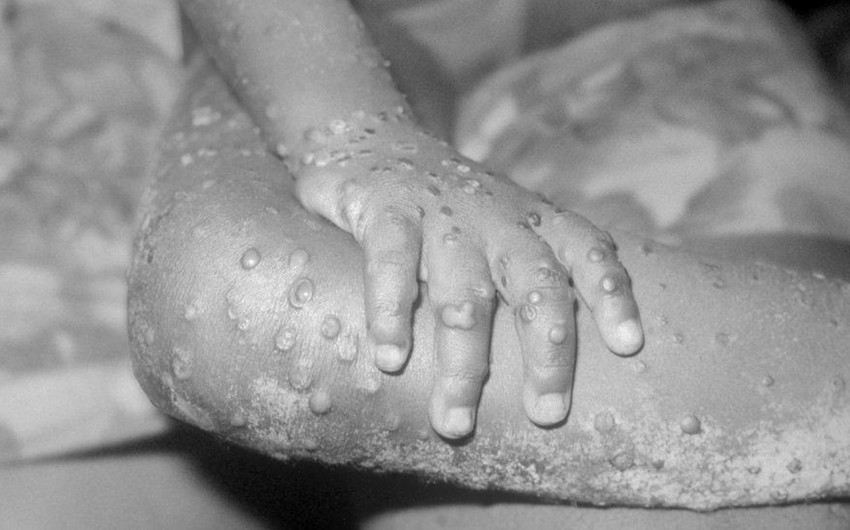 TABIB: Monkeypox can be fatal in some cases