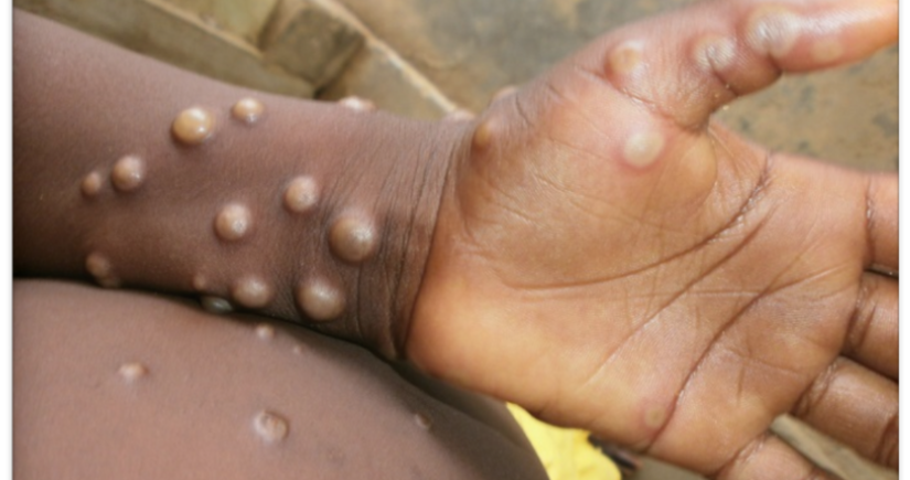 8 countries in Europe report cases of monkeypox