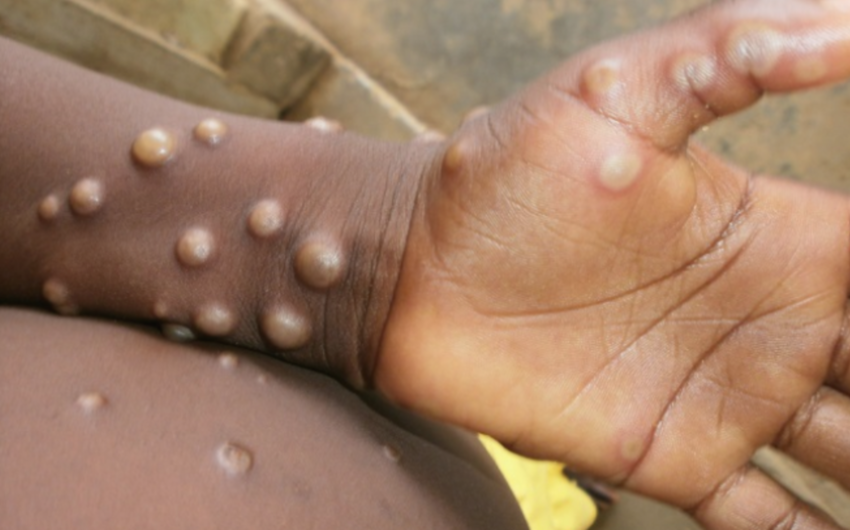 8 countries in Europe report cases of monkeypox