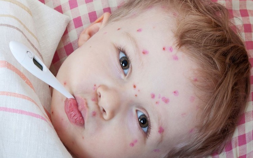 2385 people infected with measles in Georgia