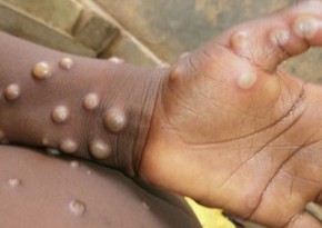 Monkeypox epidemic declared in Congo