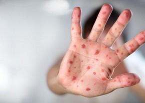 Monkeypox cases have tripled in Europe since June 15, WHO says