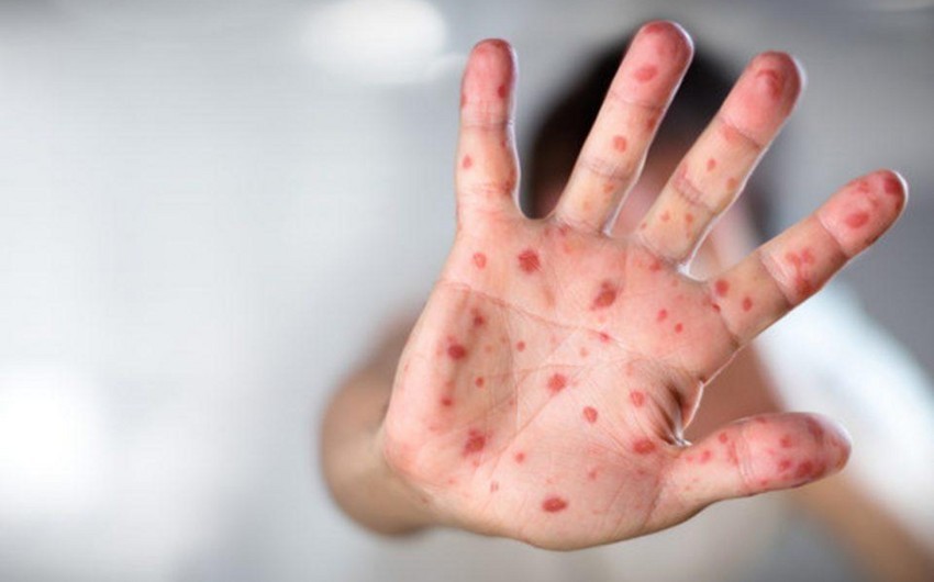 Monkeypox cases have tripled in Europe since June 15, WHO says