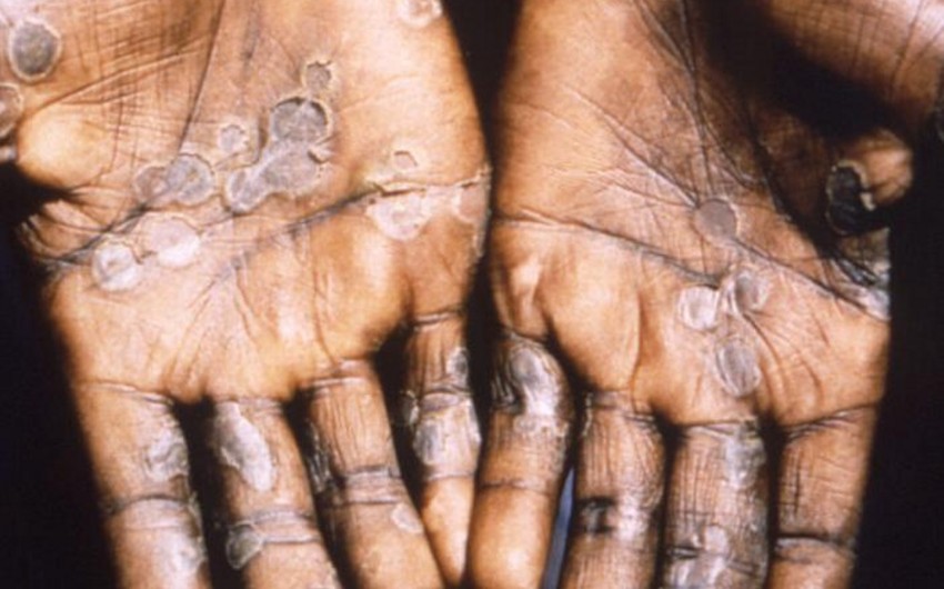 Ireland confirms its first monkeypox case