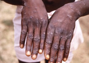 Scotland reports first case of monkeypox infection 