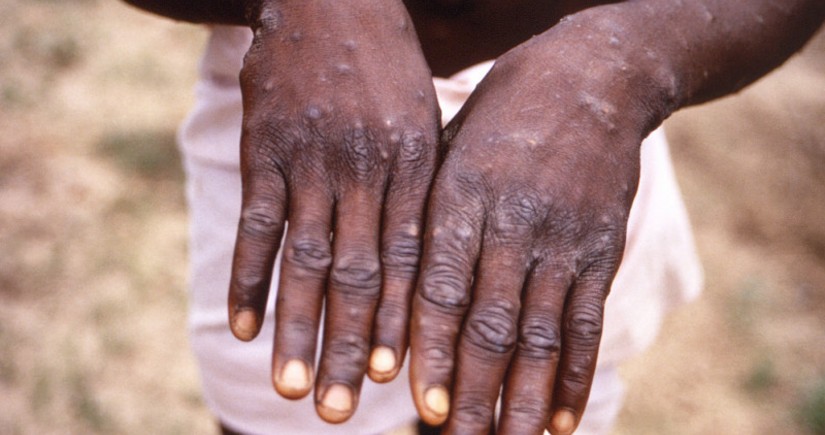 Scotland reports first case of monkeypox infection 