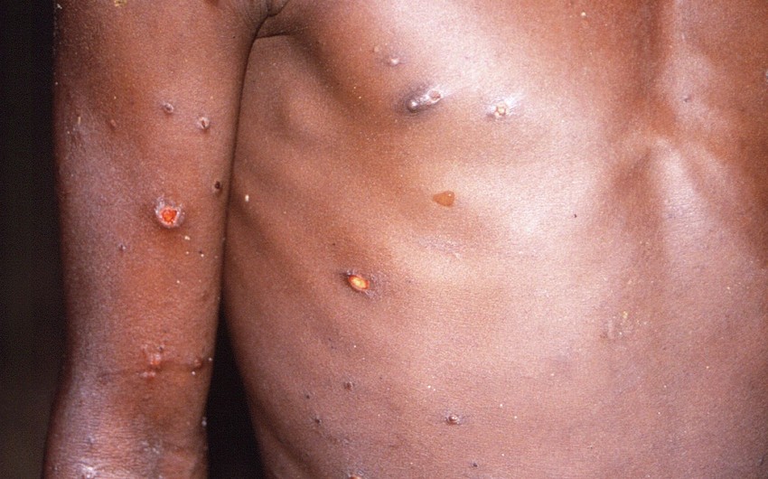 India confirms first monkeypox death