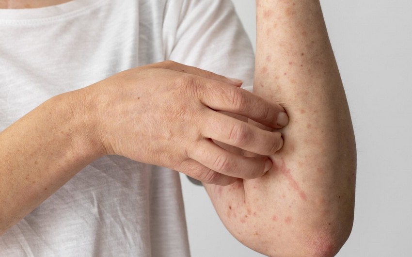 Over 58,000 measles cases recorded in WHO European region