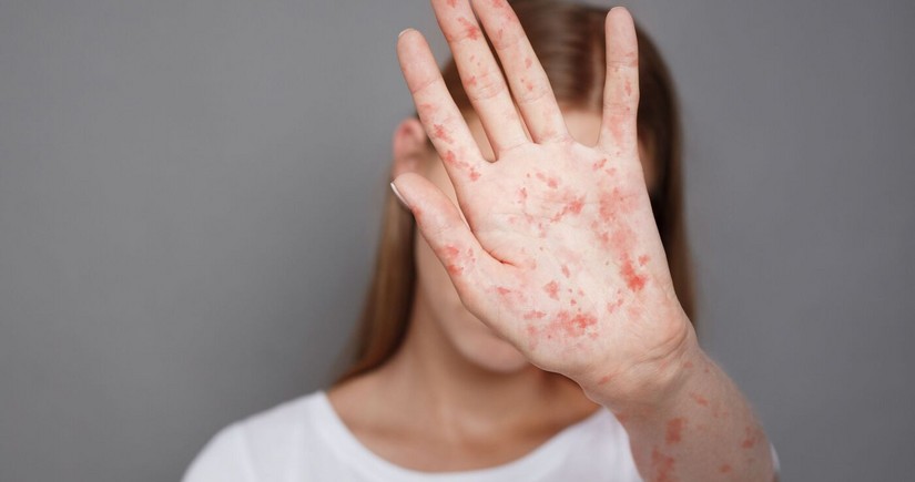 Azerbaijan records 24 cases of measles this year 