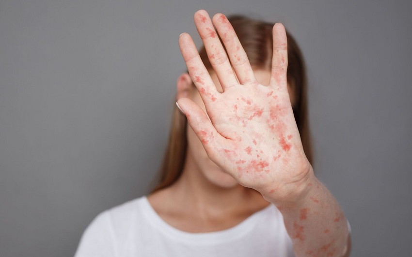 Azerbaijan records 24 cases of measles this year 