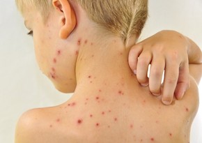 Azerbaijan records 284 cases of measles this year