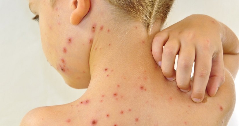 Azerbaijan records 284 cases of measles this year