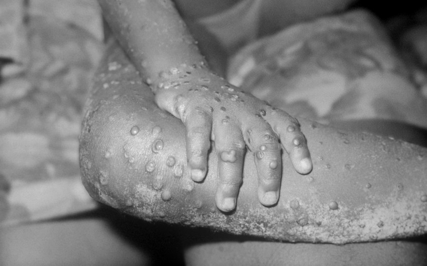 Germany to send those infected with monkeypox to 3-week isolation